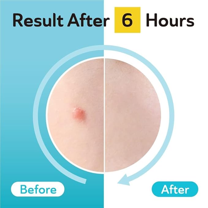 DERMA ANGEL Dark Spot Patches Blemish Patches with Hydrocolloid, TXA & CICA for Active Acne & Post-Inflammatory Dark Spots - Day and Night Use - UPGRADED (Post Acne - 96 Count - 1 Size)