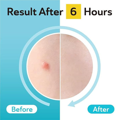 DERMA ANGEL Dark Spot Patches Blemish Patches with Hydrocolloid, TXA & CICA for Active Acne & Post-Inflammatory Dark Spots - Day and Night Use - UPGRADED (Post Acne - 96 Count - 1 Size)