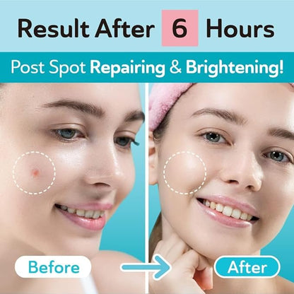 DERMA ANGEL Ultra Invisible Salicylic Acid Acne Patches and Post Acne Dark Spot Patches Bundle - Day and Night Use - UPGRADED