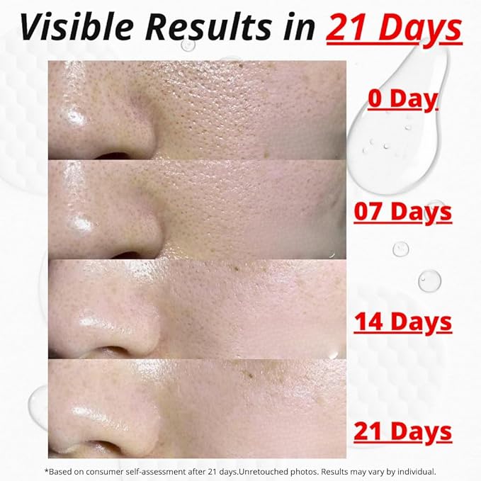 Glycolic Acid Pads for Face – Exfoliating Pads with Salicylic Acid, Niacinamide (B3), Alpha Arbutin, Vitamin B5 & B8 – Toner Pad for Clear Pores, Improve Texture, Even Skin Tone – 70 Count