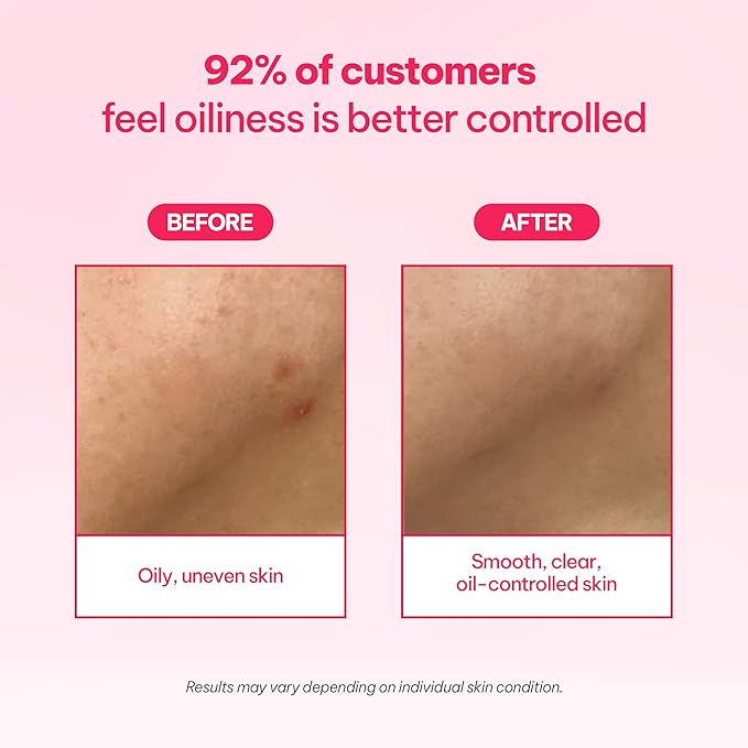 AC Triple Acid Toner 6.76 oz/200 ml – AHA/BHA/PHA Exfoliating & Hydrating Facial Toner with Salicylic Acid & Glycolic Acid for Oily Skin, Pore Cleaning, Acne & Sebum Control, Korean Skincare