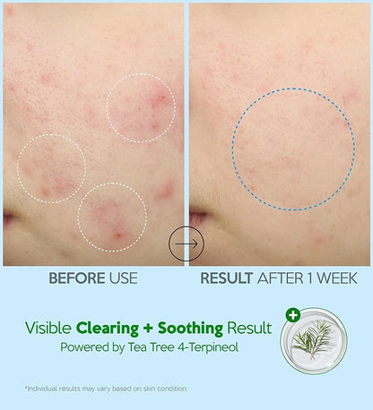 Troubless Hydro Soothing Moisture Cream - Deep Hydration & Skin Barrier Cream for Face w/ 10,000 ppm Panthenol & Tea Tree 4-Terpineol - Soothing & Non-Greasy Face Moisturizer (2.36 fl oz)