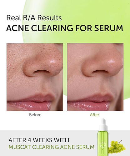 SERUMKIND Muscat Discoloration Correcting facial serum - 1fl oz - Blemishes & blackhead remover - Vegan Not Tested on Animals - Korean Skin Care - PHA Redness Relief and Exfoliating