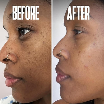 Dark Spot Corrector, Dark Spot Remover for Face - For Stubborn Dark Spots Serum, Dark Spot Remover with Kojic Acid, Alpha Arbutin, Mulberry Extract, Brightening Discoloration Correcting Serum