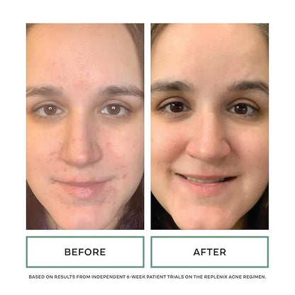 Replenix Gly-Sal Clarifying Acne Pads, 60 Count, Medical-Grade Glycolic Acid & 2% Salicylic Acid Exfoliating Pads for Acne-Prone Skin, Help Clear Blemishes & Refine Pores, Non-Oily