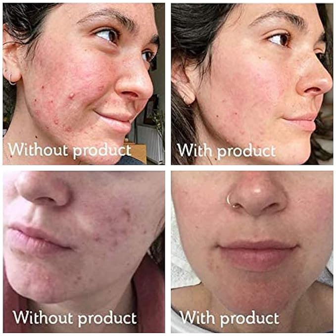 Science of Skin Rescue No. One For Spot, Blemish and Acne Scars