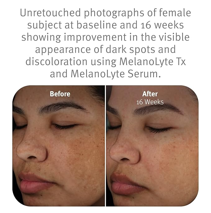 Epionce MelanoLyte Tx - Botanical-Based Product for Uneven Skin Tone, For All Skin Types, Contains Licorice Root Extract, Dermatologist Skincare