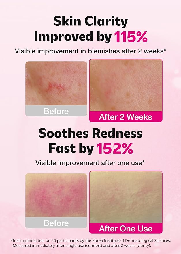 ISOI Blemish Care Up Serum for Face, Vegan Hydrating Serum for Smooth & Glass Skin Effect, Skin Barrier & Moisture Balance for Women, Arbutin, Korean Skin Care (1.18 fl. oz, 35ml)