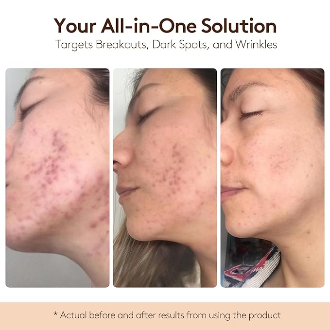 BIOCHEM DL-Mandelic Acid 10% Facial Renewal Ampoule - Gentle AHA Exfoliation Treatment for Discoloration, Dullness, Uneven Skin Tone, Wrinkles, and Fine Lines for All Skin Types - 1.01 Fl. Oz. / 30 mL