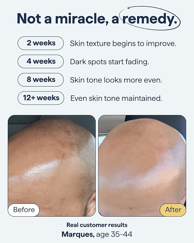 Remedy for Dark Spots – Discoloration Treatment For Face with Retinol, Glutathione, Niacinamide, Mandelic Acid, Kojic Acid and Tranexamic Acid – By Dermatologist Dr. Shah