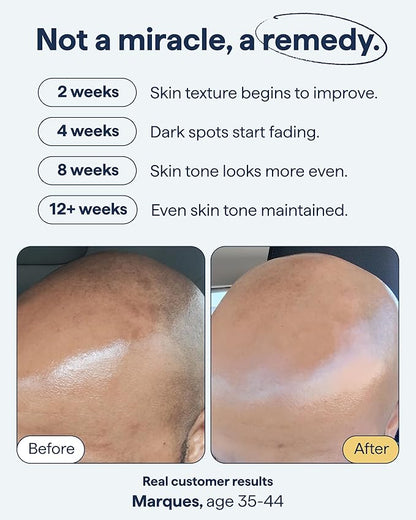 Remedy for Dark Spots – Discoloration Treatment For Face with Retinol, Glutathione, Niacinamide, Mandelic Acid, Kojic Acid and Tranexamic Acid – By Dermatologist Dr. Shah