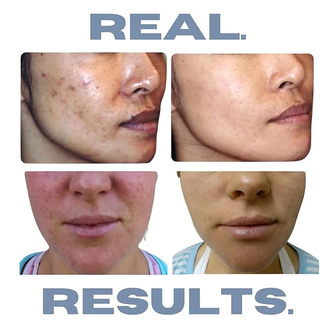 Clearogen Clarifying Toner for Acne and Blemishes, Face Toner, Facial Toner, Skin Toner, Acne Toner, Toner Oily Skin, Salicylic Acid Toner, Astringent for Face, Toners, 4 Fl Oz