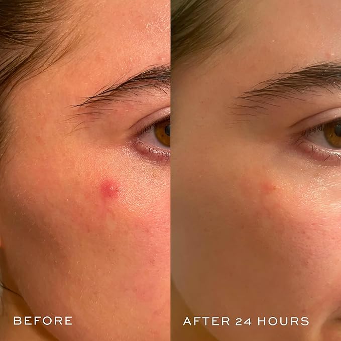 DIME Beauty Power Patch, 72 Count - Hydrocolloid Pimple Patches, Zit Spot and Blemish Aid with Salicylic Acid, Vitamin A, and Clove Oil