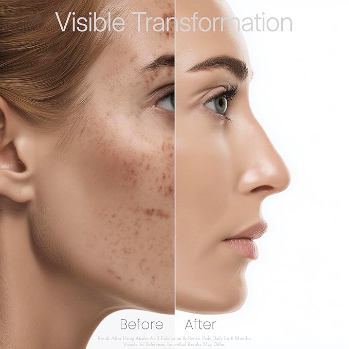 A+B Exfoliating & Repair Face Pads 30 Tx - 2-Step Acid Peel Serum Treatment with Glycolic, Salicylic, Kojic Acid & Retinol Hyaluronic Peptides for Smooth Skin, Pore Minimizer, Hyperpigmentation