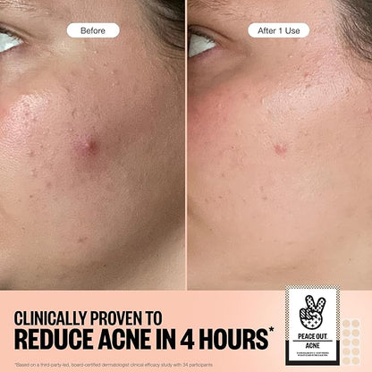 PEACE OUT Acne Healing Dots Helps Clear Blemishes Overnight, Fast Acting Hydrocolloid Pimple Patches for Breakouts with Salicylic Acid, Retinol and Aloe Vera, Award Winning Skincare Solution 40 Count