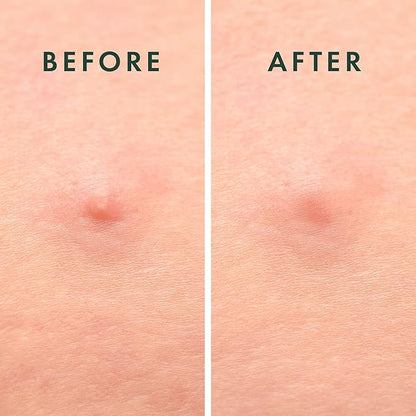 Rael Pimple Patches, Miracle Microcrystal Spot Cover - Hydrocolloid Acne Patch with Tea Tree Oil, Early Stage Zits and Blemish, Korean Skin Care (27 Count)