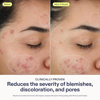 Skinfix 2% BHA Cleanser - 5 oz - Clears Acne Blemishes & Blackheads - Safe for All Types of Acne - Fragrance Free - Vegan, Cruelty Free